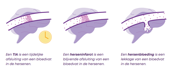 Meer over beroerte